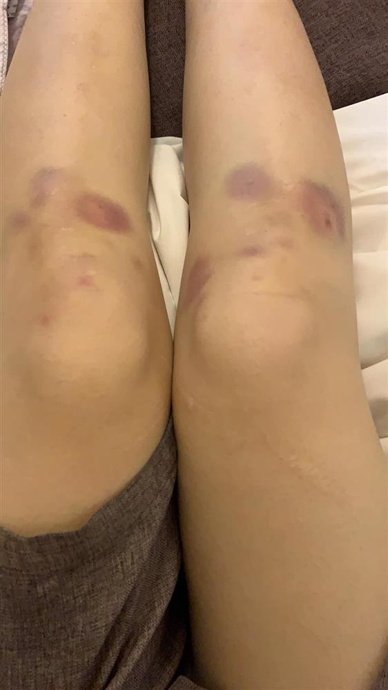 Lan Ngọc chân đầy hoa gấm vì lăn xả Running Man, nhìn mà xót!-8