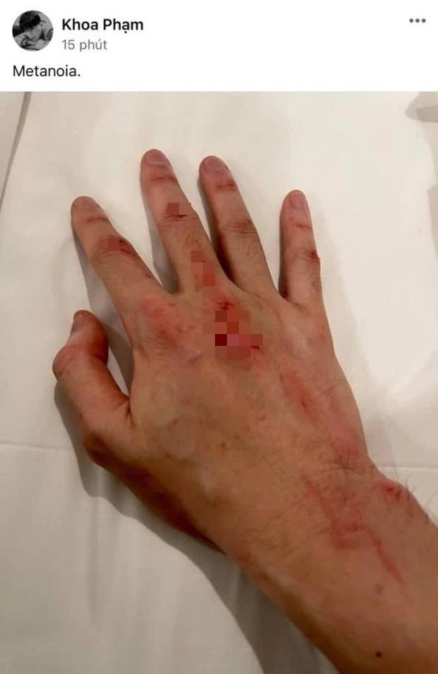 Karik gây lo lắng với bức ảnh chụp bàn tay trầy xước dính máu-1