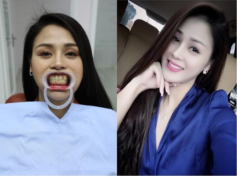 Lương Thu Trang ê chề vì ngã gãy răng khi quay Mặt Nạ Gương-8