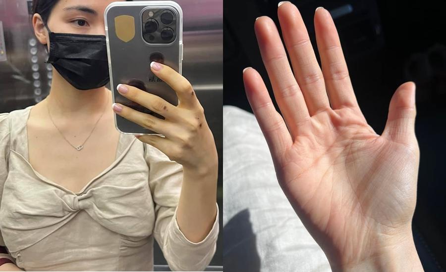 Phát hiện da bất thường, Hòa Minzy đi khám, kết quả ra sao?-3