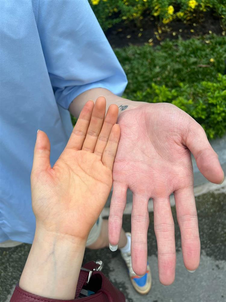 Phát hiện da bất thường, Hòa Minzy đi khám, kết quả ra sao?-2