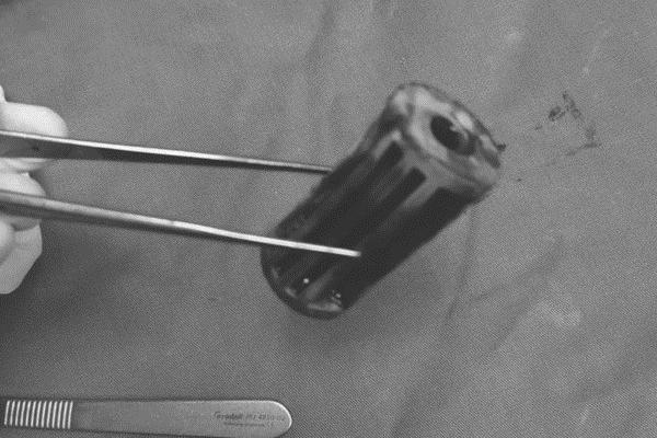 Học theo phim ảnh, bé trai 5 tuổi nhét thanh sắt vào hậu môn-3