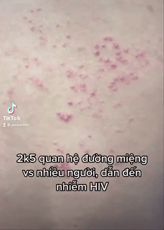 Nam sinh 16 tuổi suy sụp khi nhiễm HIV vì 1 kiểu quan hệ tình dục-2