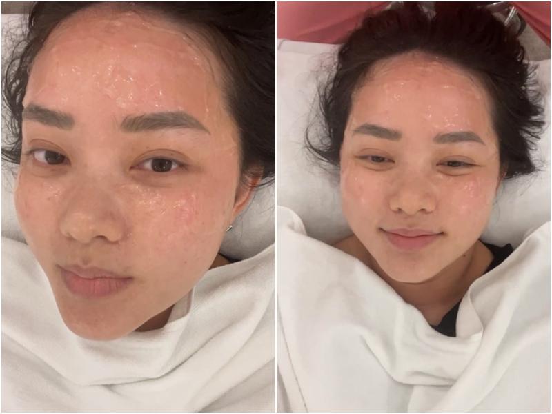 Phan Như Thảo chịu tra tấn như bị gõ búa lên mặt để trẻ hóa da-4