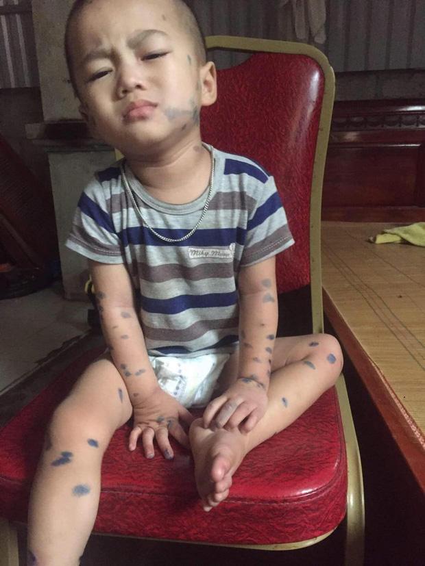 Bé 2 tuổi mắc 2 căn bệnh ung thư, cứ lẩm bẩm con chết, con chết-4