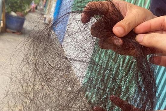 Ám ảnh rùng mình di chứng rụng tóc của người từng mắc Covid-19