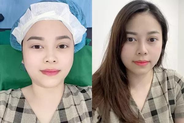 Không nhận ra Hằng Túi sau ca can thiệp mặt mũi-7
