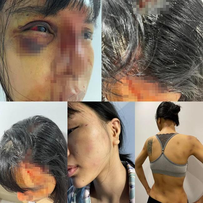 Khả Trang sau loạt bạo hành: Mặt vẫn sưng, mắt tụ máu-2