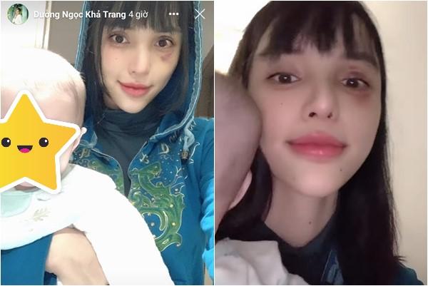 Khả Trang sau loạt bạo hành: Mặt vẫn sưng, mắt tụ máu-5