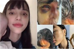 Khả Trang sau loạt bạo hành: Mặt vẫn sưng, mắt tụ máu