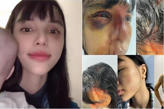 Khả Trang sau loạt bạo hành: Mặt vẫn sưng, mắt tụ máu