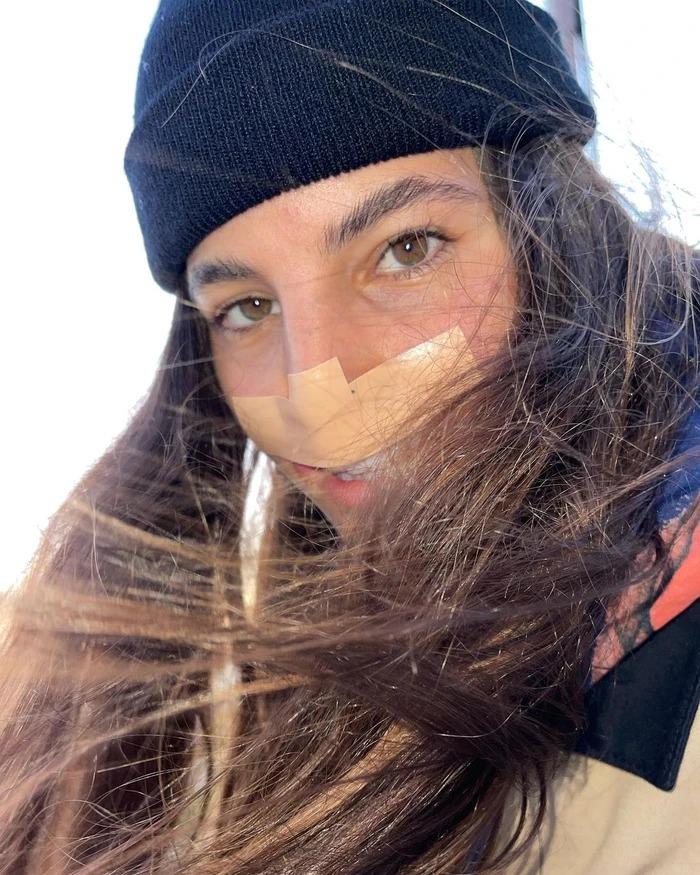 Nữ người mẫu chi 9 tỷ phẫu thuật vì bị chó cắn đứt môi trên-2