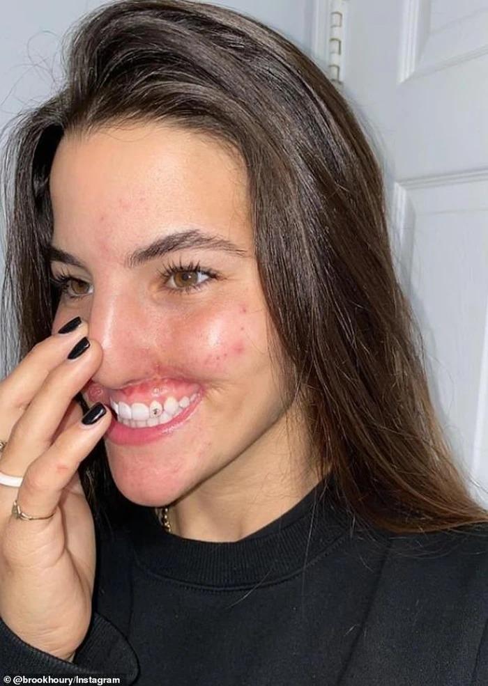 Nữ người mẫu chi 9 tỷ phẫu thuật vì bị chó cắn đứt môi trên-3