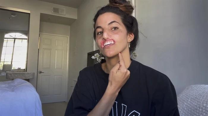 Nữ người mẫu chi 9 tỷ phẫu thuật vì bị chó cắn đứt môi trên-4