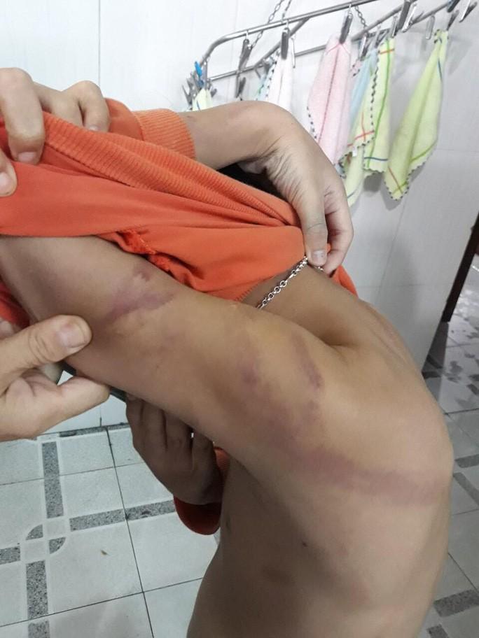 Học chậm tiến, bé trai 7 tuổi bị bố đánh dã man-4