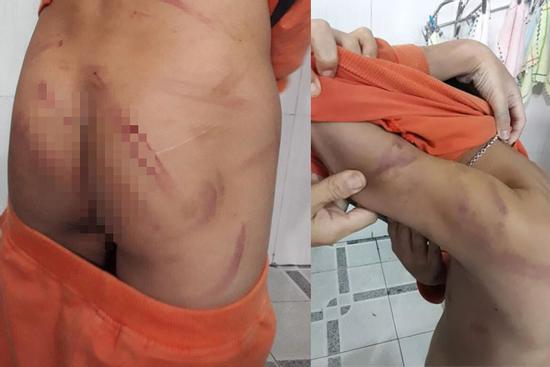 Học chậm tiến, bé trai 7 tuổi bị bố đánh dã man