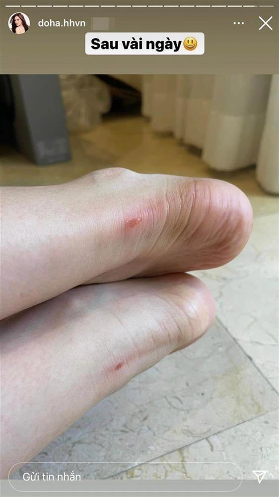 Đôi chân 1m11 của Đỗ Thị Hà lại toang vì ong đốt phù nề-3