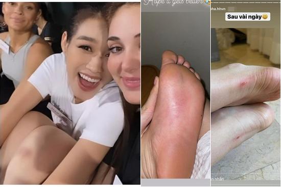 Đôi chân 1m11 của Đỗ Thị Hà lại 'toang' vì ong đốt phù nề