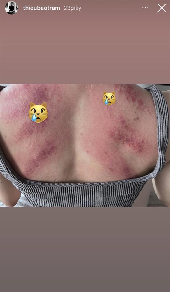 Thiều Bảo Trâm gây hoang mang khi lộ cơ thể chi chít vết đỏ bầm-1