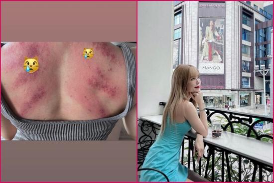 Thiều Bảo Trâm gây hoang mang khi lộ cơ thể chi chít vết đỏ bầm