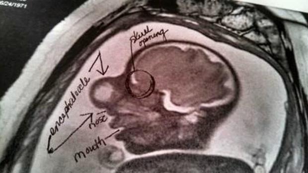 Cậu bé sinh ra bị khối u khổng lồ che lấp gây bất ngờ với diện mạo hiện tại-2
