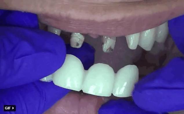 Nghệ sĩ bọc răng sứ: Đẹp và nhanh thật nhưng phải cân nhắc kĩ-4