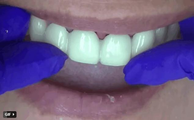 Nghệ sĩ bọc răng sứ: Đẹp và nhanh thật nhưng phải cân nhắc kĩ-5