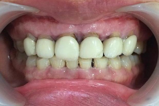 Nghệ sĩ bọc răng sứ: Đẹp và nhanh thật nhưng phải cân nhắc kĩ-6