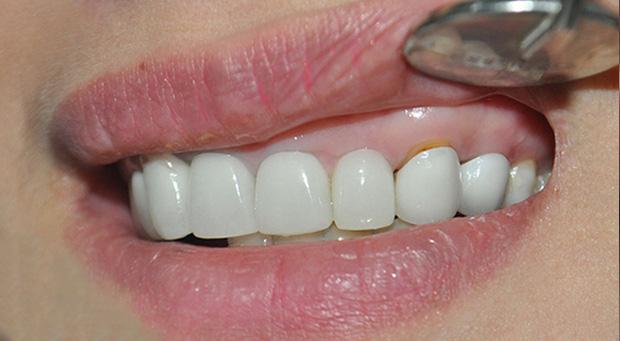 Nghệ sĩ bọc răng sứ: Đẹp và nhanh thật nhưng phải cân nhắc kĩ-7
