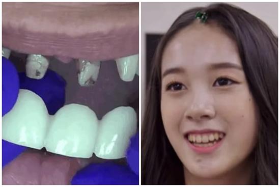 Nghệ sĩ bọc răng sứ: Đẹp và nhanh thật nhưng phải cân nhắc kĩ