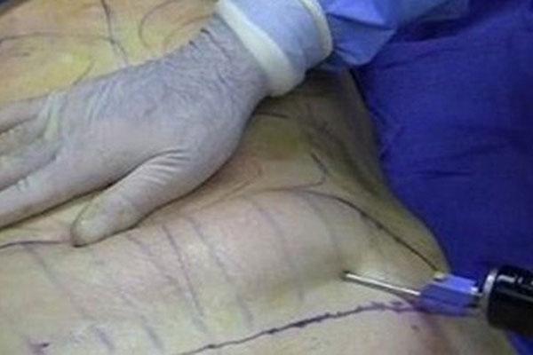 Đi hút mỡ bụng tử vong, thẩm mỹ viện gọi về báo cô ấy còn hấp hối-1