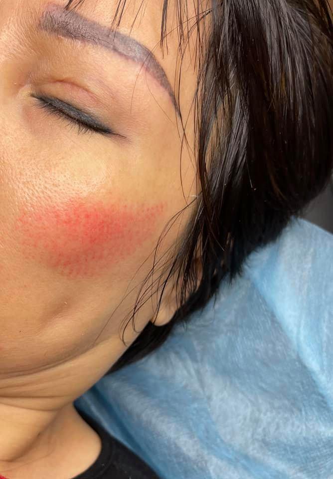 Sự thật về cấy má hồng baby, nghe xong mà muốn ngất lịm!-6