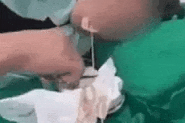 Clip: Rợn người bác sĩ kéo ra con sán dài 6m từ miệng bà cô ở Sơn La-1