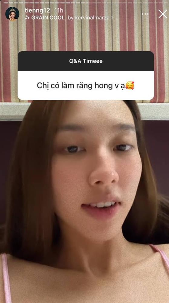 Miss Grand Thùy Tiên thừa nhận đã dao kéo vì cười hở lợi-2