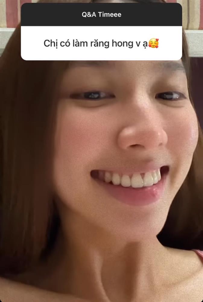 Miss Grand Thùy Tiên thừa nhận đã dao kéo vì cười hở lợi-3