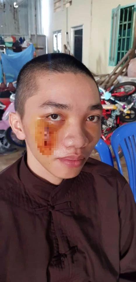 Tu sĩ Tịnh thất Bồng Lai đòi kiện lấy đủ 3 tỷ vì vết sẹo trên mặt-3