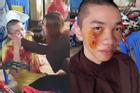 Tu sĩ 'Tịnh thất Bồng Lai' đòi kiện lấy đủ 3 tỷ vì vết sẹo trên mặt