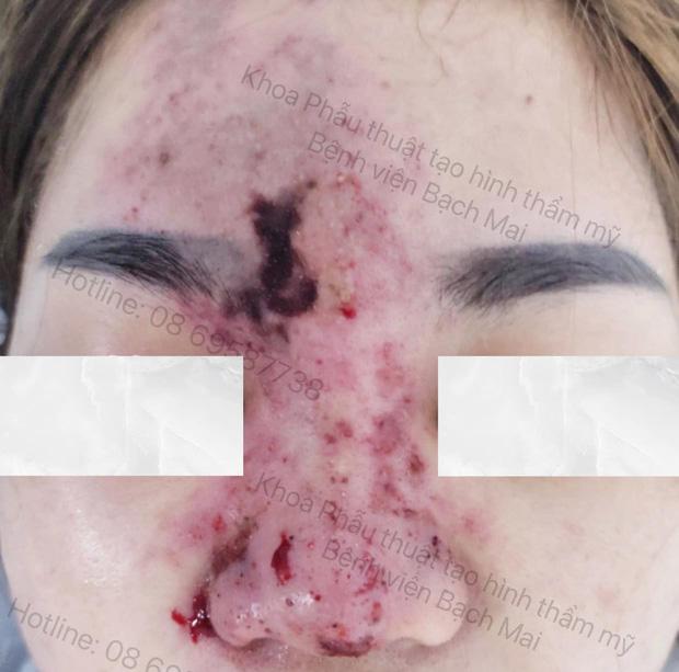 Cô gái 25 tuổi bị hoại tử vùng mũi, trán sau khi tiêm filler làm đẹp-1