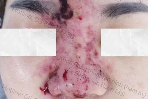 Ham tiêm filler giá rẻ, người phụ nữ nhận về đôi môi biến dạng-3