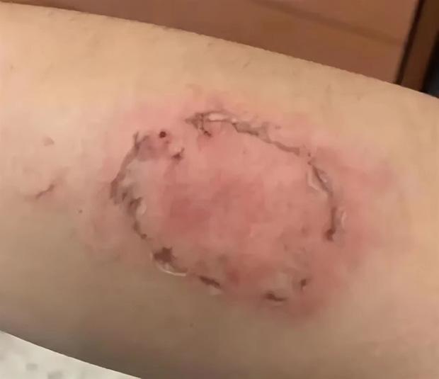 Đi đổ xăng, thanh niên bị kẻ lạ lao vào cắn mặt, xé nát quần lót-2