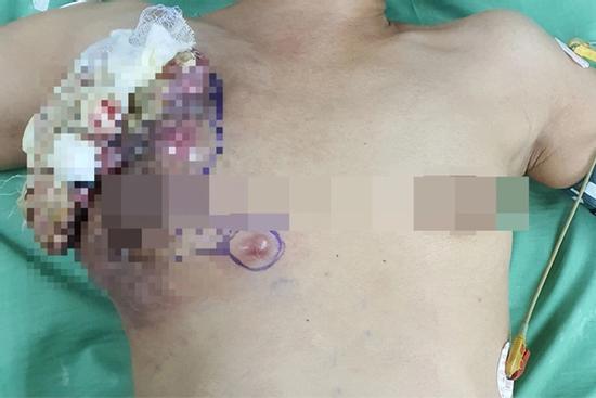 Nữ bệnh nhân bị sùi loét ngực, bốc mùi hôi thối vì không đi khám