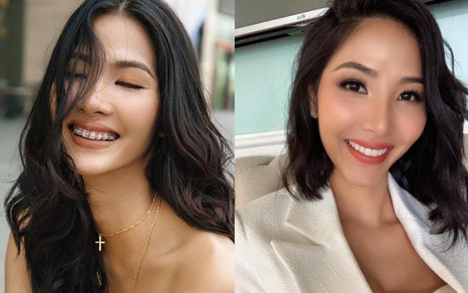 Nụ cười của Hoàng Thùy thêm tươi tắn nhờ hàm răng trắng đều. Trước khi chinh chiến tại Miss Universe 2019, cô quyết định nhập hội "răng sắt" để cải thiện nhan sắc.