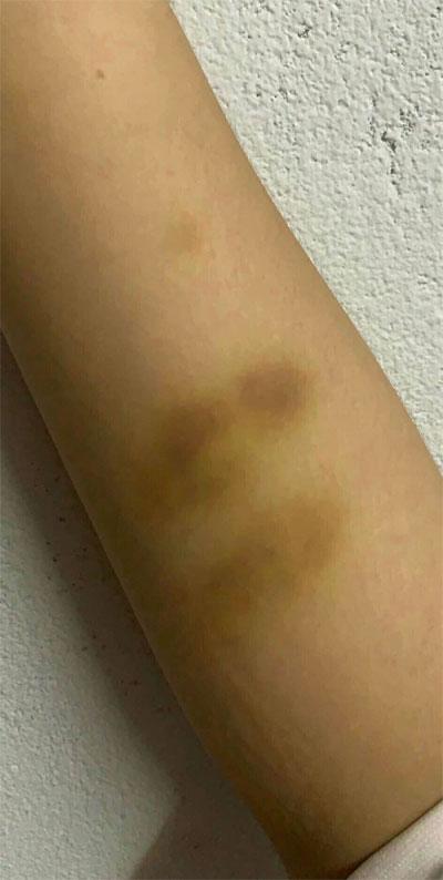 Nữ sinh F0 nghi bị chủ trọ hành hung, đuổi cổ giữa đêm: Biến-3