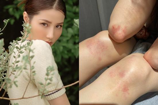 Diễm My 9X khoe thương tích, đồng nghiệp lo lắng