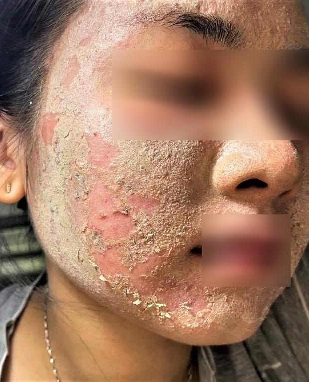 Da nát tan vì tin vào lọ serum tá công dụng, bác sĩ đưa lời khuyên-1