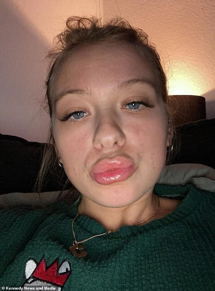 Ham tiêm filler giá rẻ, người phụ nữ nhận về đôi môi biến dạng-2