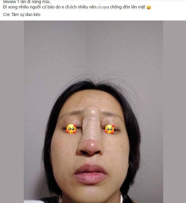 Review nâng mũi, cô gái gây hãi hùng khi nhìn thành quả-1