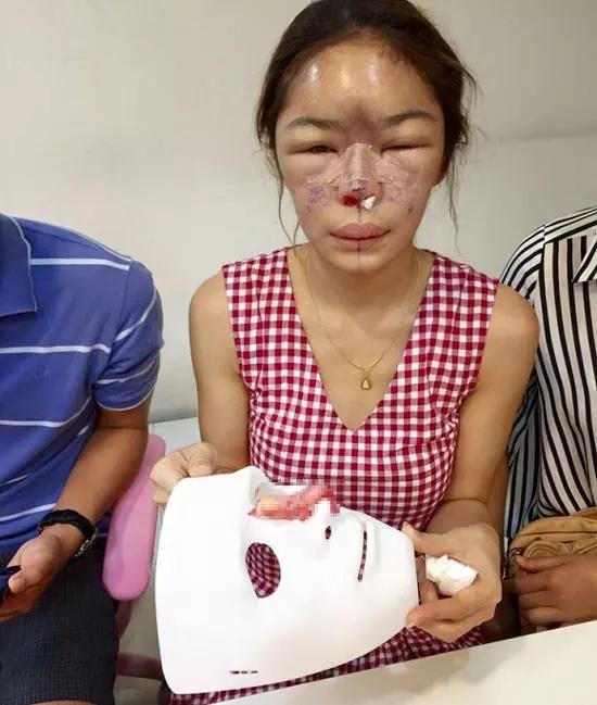 Review nâng mũi, cô gái gây hãi hùng khi nhìn thành quả-5