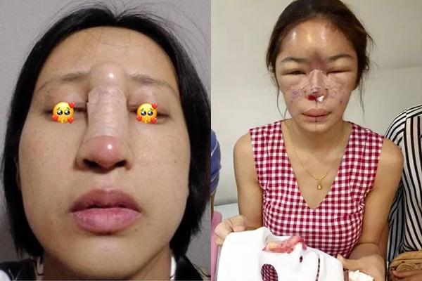 Già vẫn ham hố nâng mũi, bà mẹ nhận kết thảm thương-10