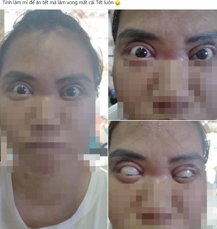 Một phụ nữ nguy cơ mù sau khi cắt mí mắt ở cơ sở thẩm mỹ chui-5